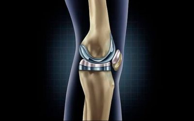 Las inyecciones de corticosteroides intraarticulares aumentan el riesgo de requerir una artroplastia de rodilla