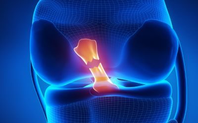 ¿Cómo saber si me rompí el ligamento cruzado anterior?