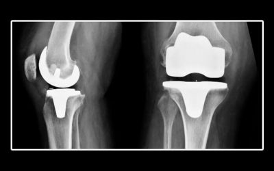 Complicaciones tromboembólicas y hemorrágicas después de una artroplastia total de rodilla primaria: Un estudio de cohorte nacional danés