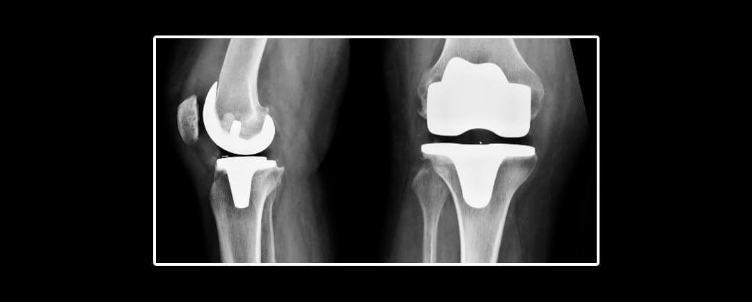 Complicaciones tromboembólicas y hemorrágicas después de una artroplastia total de rodilla primaria: Un estudio de cohorte nacional danés - Cirugía de rodilla Guadalajara