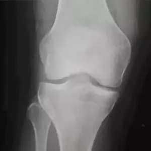 Osteosintesis de Rodilla - Traumatólogo y Ortopedista