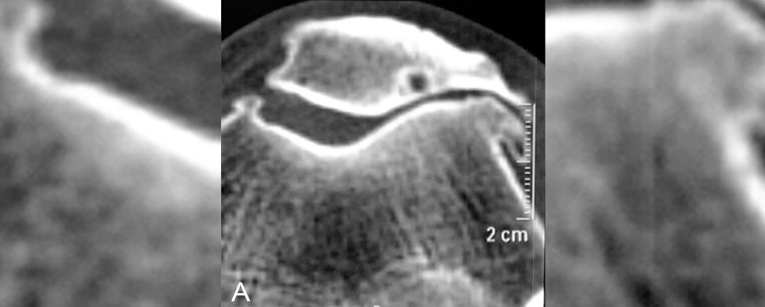 Artrosis patelofemoral