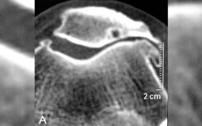 Artrosis patelofemoral