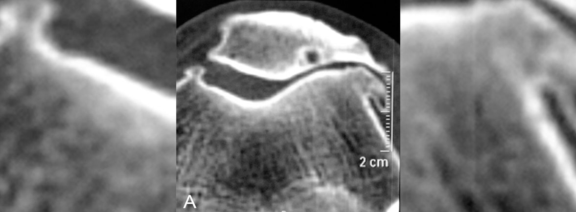 Artrosis patelofemoral