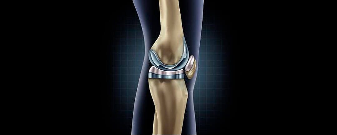 Las inyecciones de corticosteroides intraarticulares aumentan el riesgo de requerir una artroplastia de rodilla