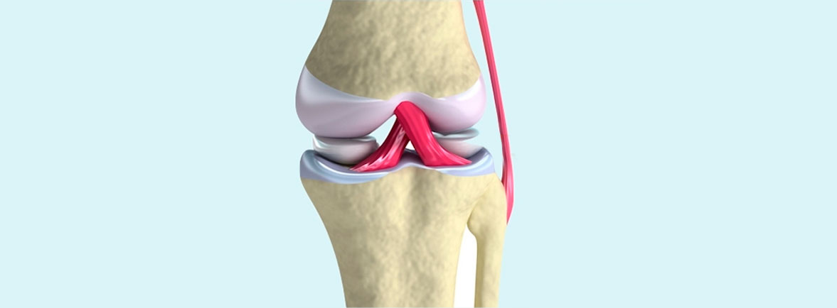 Lesiones de cartílago en rodilla
