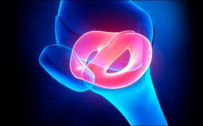 Menisco discoide en niños y adolescentes