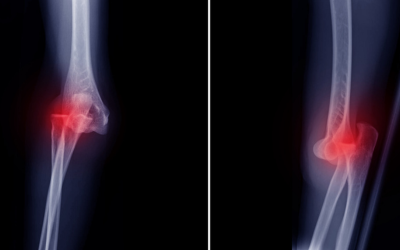 Luxación Traumática: La lesión de rodilla más grave (y por qué no debes entrar en pánico)