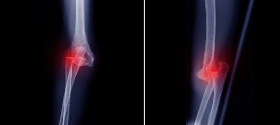 Luxación Traumática: La lesión de rodilla más grave (y por qué no debes entrar en pánico)