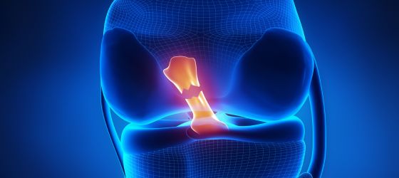 ¿Cómo saber si me rompí el ligamento cruzado anterior?