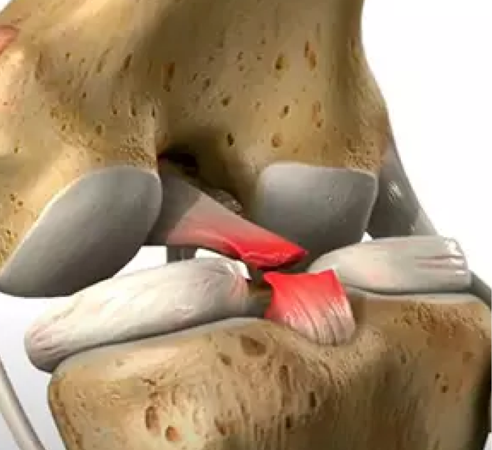 Ilustración médica en 3D de la articulación de la rodilla mostrando una ruptura de ligamento cruzado