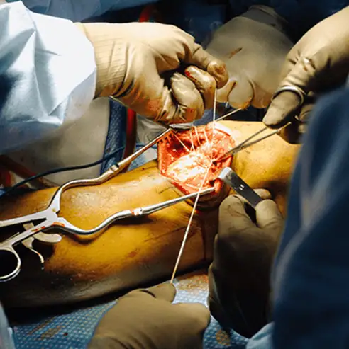 Intervención quirúrgica para la reconstrucción de ligamentos cruzados de rodilla